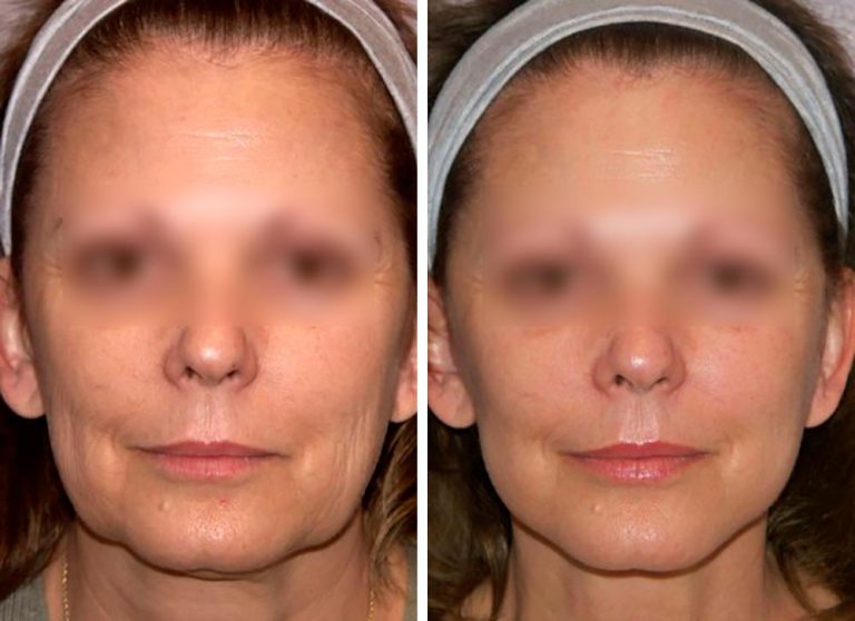 Elasthase benefits